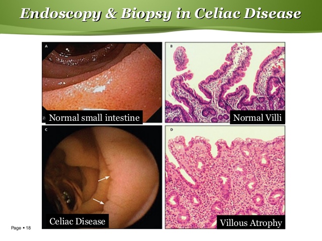 celiac endoscopy findings