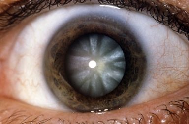 صورة توضح عينا مصابة بالساد (يتمثل هذا المرض في البقعة البيضاء التي تكونت بمركز العدسة)