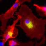 صورة لخلايا جدعية ملتفة حول خلايا سرطانية